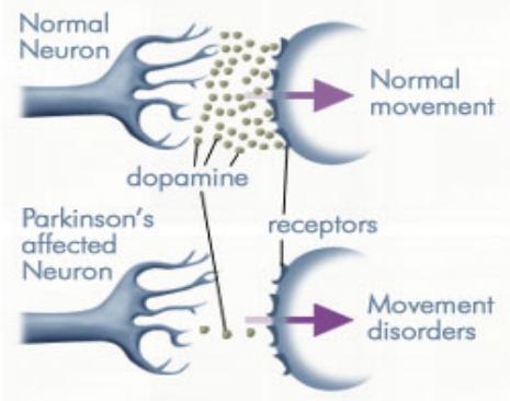 Normal Neuron Parkinson's affected Neuron Dopamine Movement Disorders - Best Personal Trainers and Nutrition Consulting in Dubai AbhiFit
